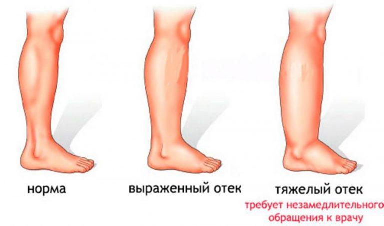 Какой стороной прикладывать лопух к ноге при варикозе фото